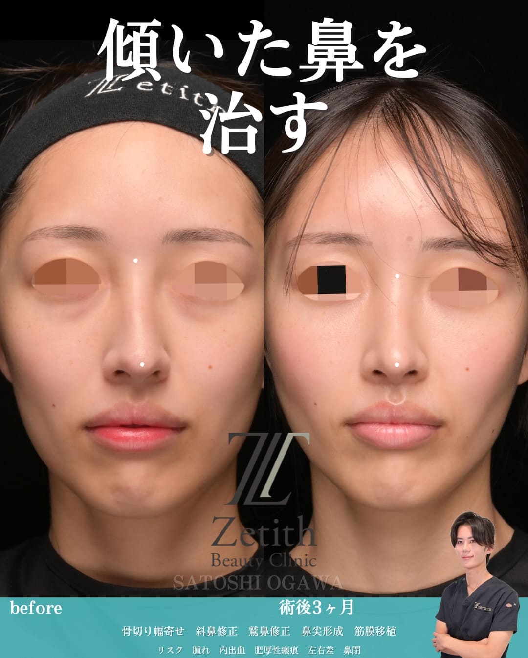 鼻整形のビフォーアフター写真(術前)