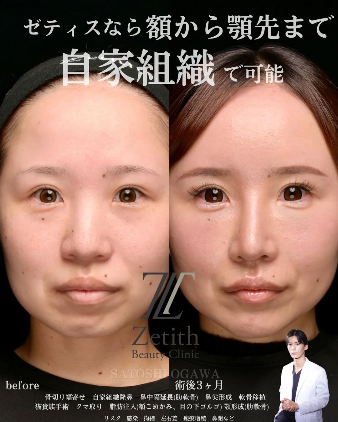 鼻整形のビフォーアフター写真(術前)