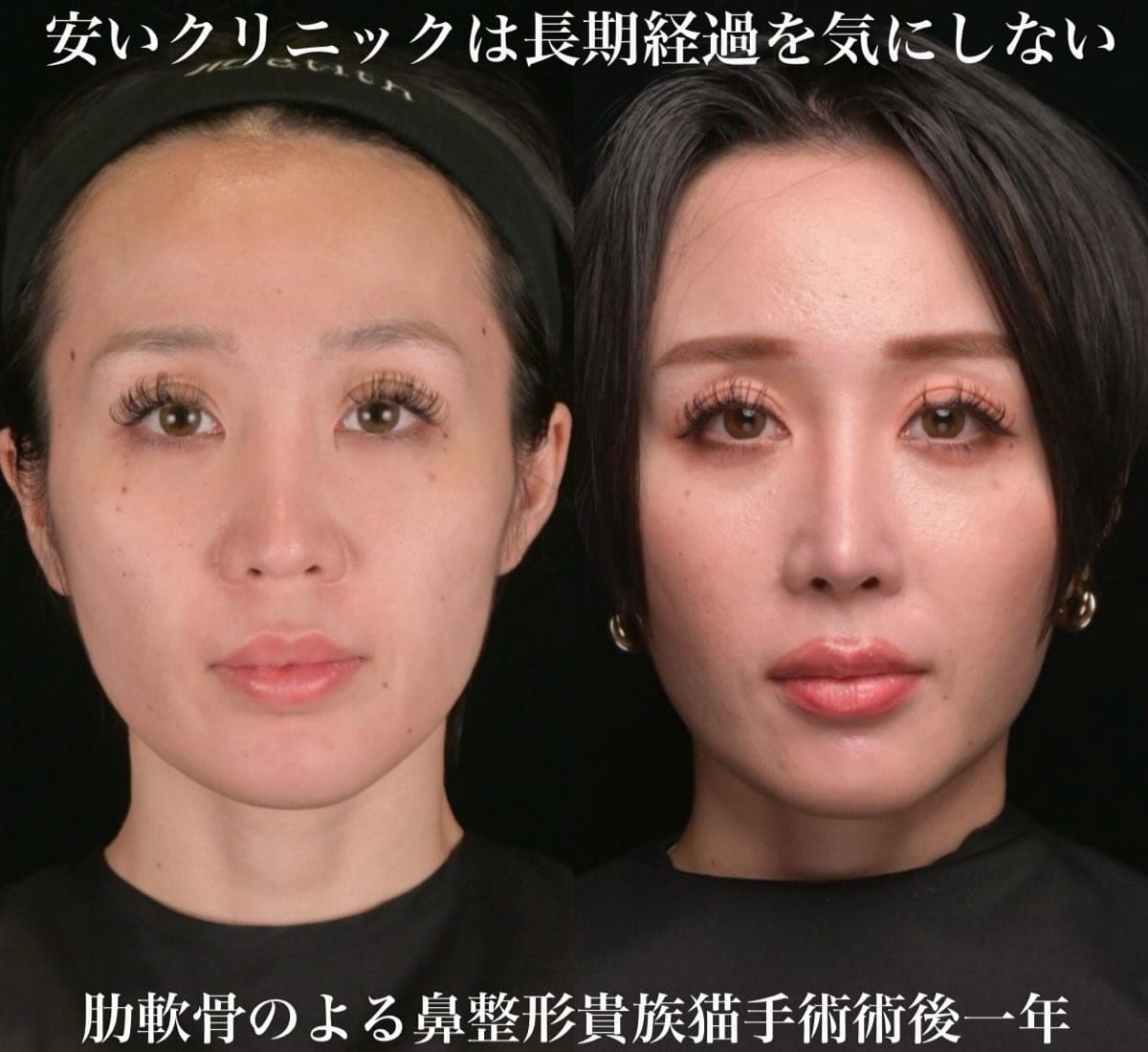 鼻整形のビフォーアフター写真(術前)
