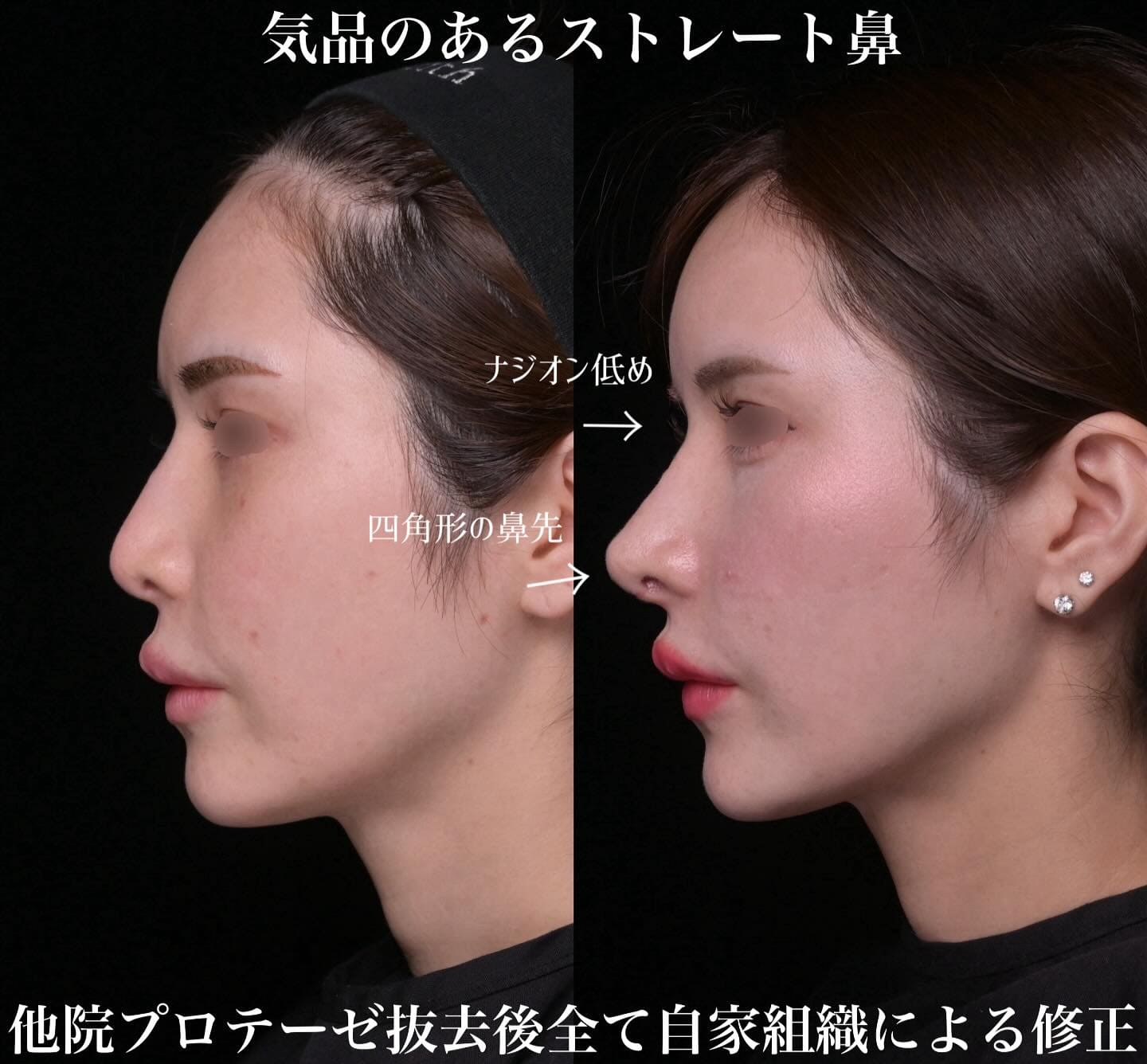鼻整形のビフォーアフター写真(術前)