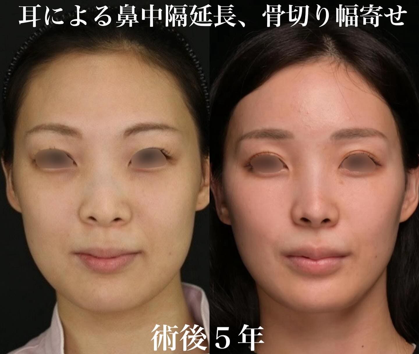 鼻整形のビフォーアフター写真(術前)