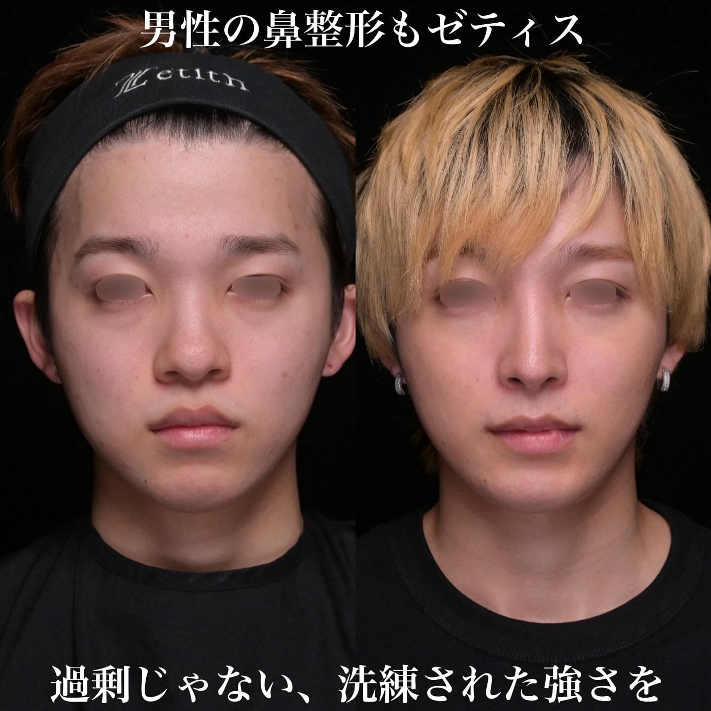 鼻整形のビフォーアフター写真(術前)