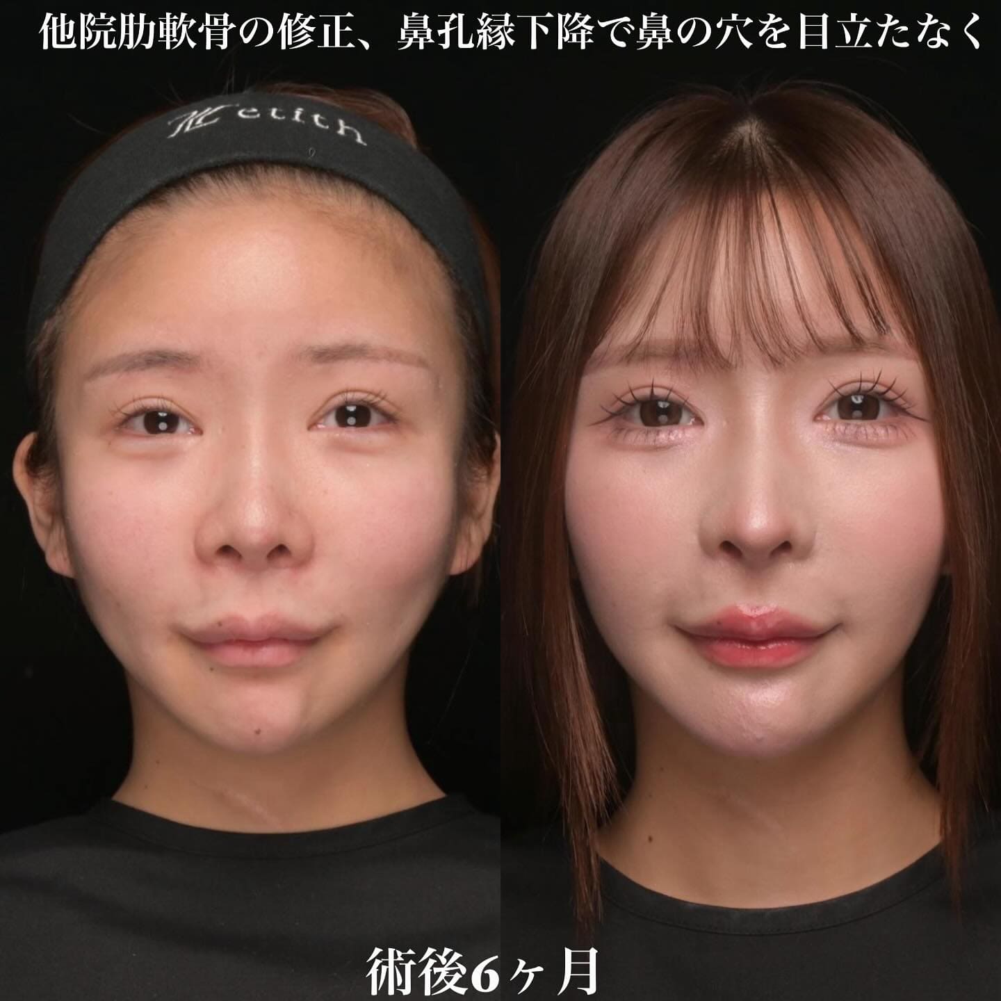 鼻整形のビフォーアフター写真(術前)