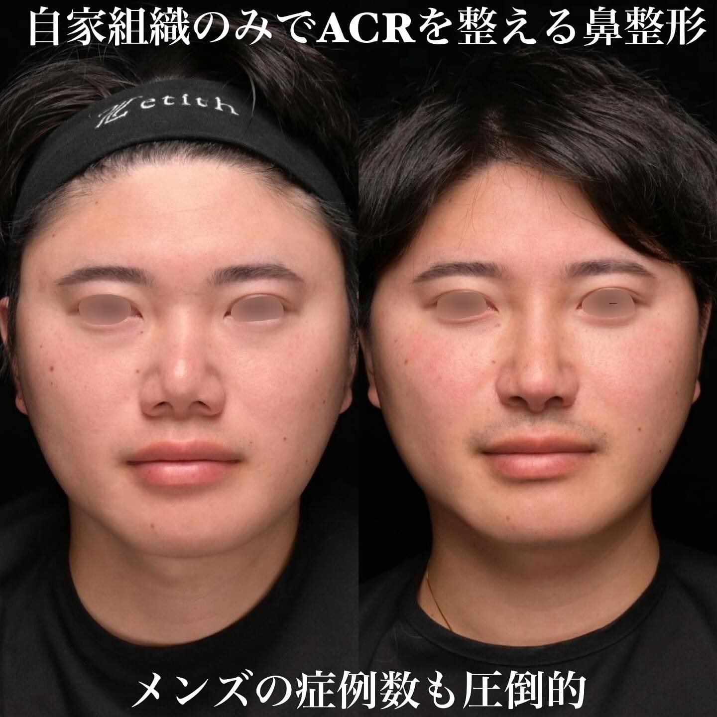 鼻整形のビフォーアフター写真(術前)