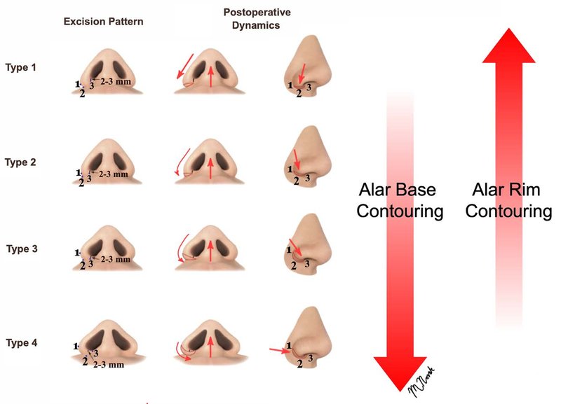 . The alar base surgery spectrum, showing resection patterns and postoperative dynamics for each type of alar flare.
