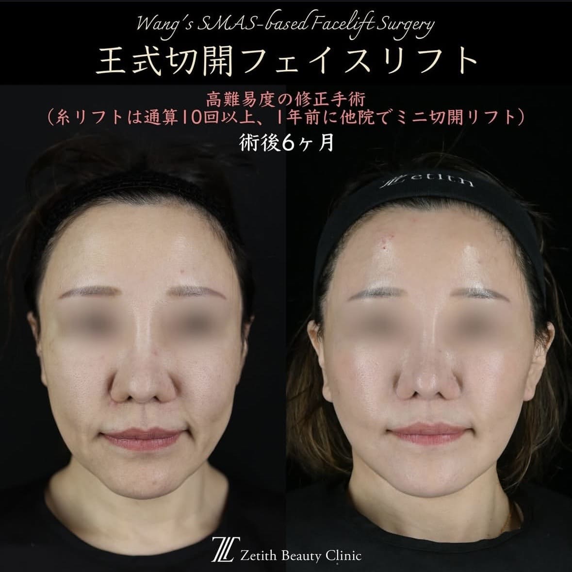 フェイスリフトのビフォーアフター写真