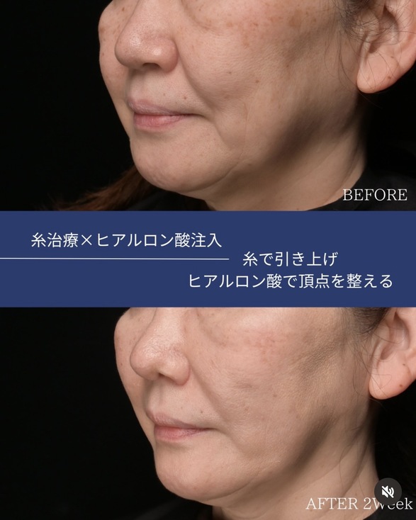 糸リフトのビフォーアフター写真