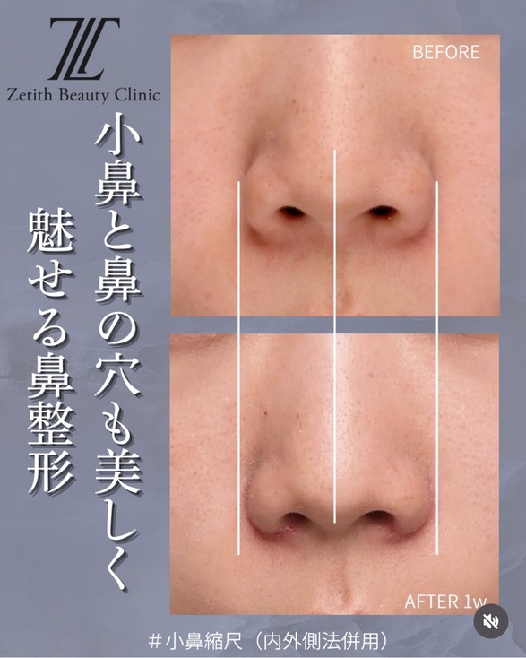 鼻整形のビフォーアフターの写真