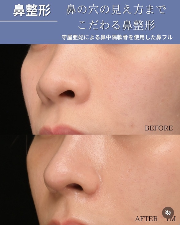 鼻整形のビフォーアフターの写真