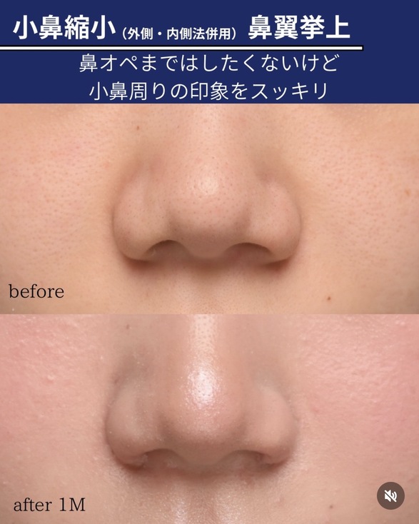 鼻整形のビフォーアフターの写真
