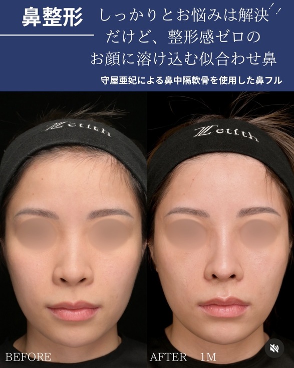 鼻整形のビフォーアフターの写真