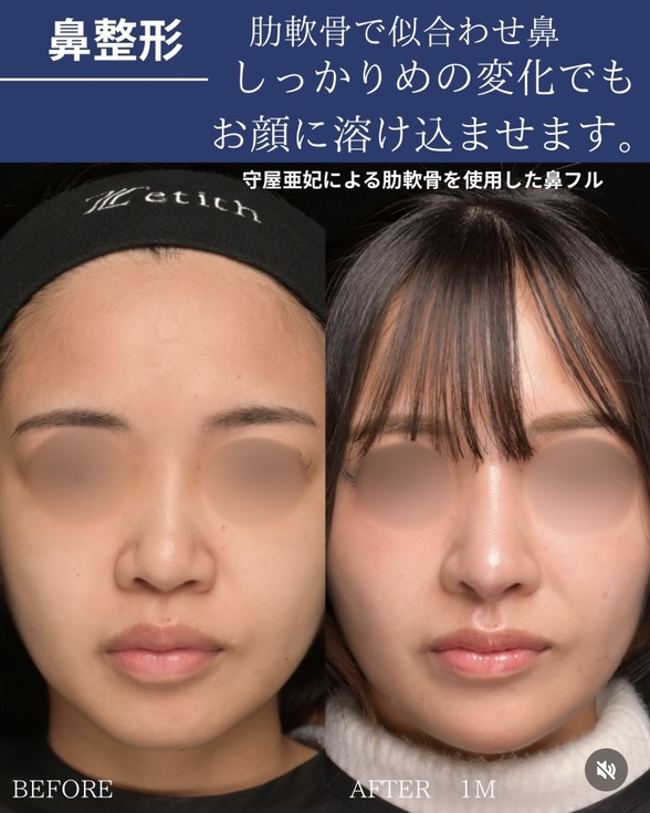鼻整形のビフォーアフターの写真