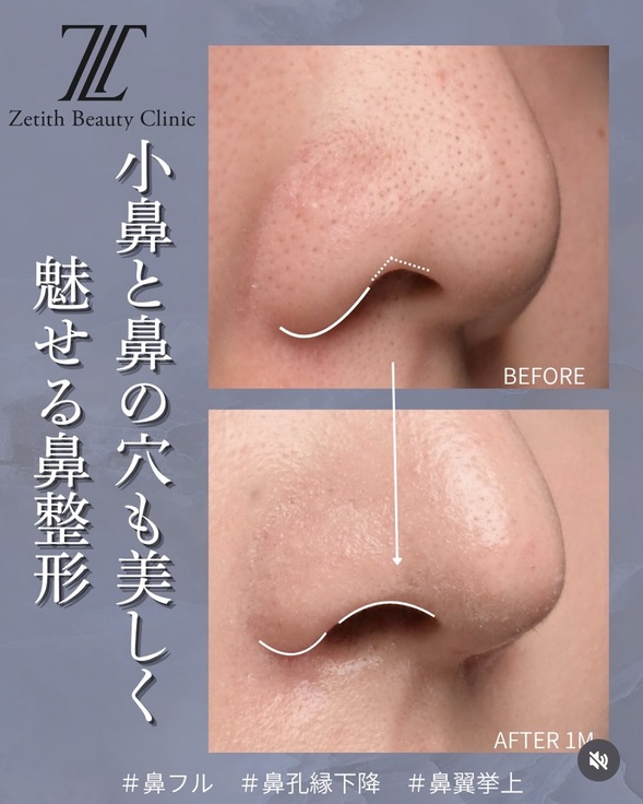 鼻整形のビフォーアフターの写真