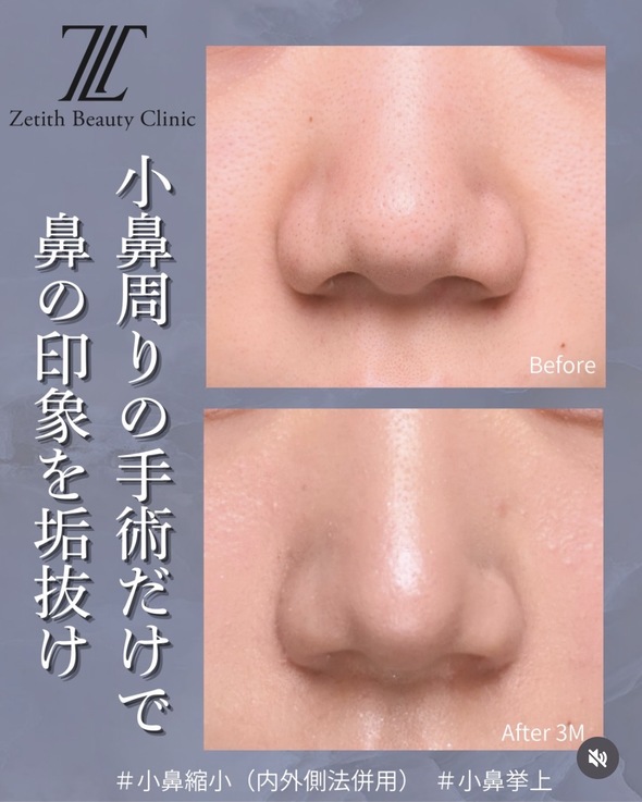 鼻整形のビフォーアフターの写真
