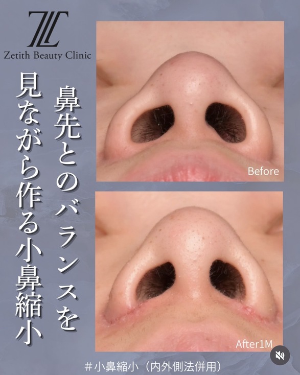 鼻整形のビフォーアフターの写真