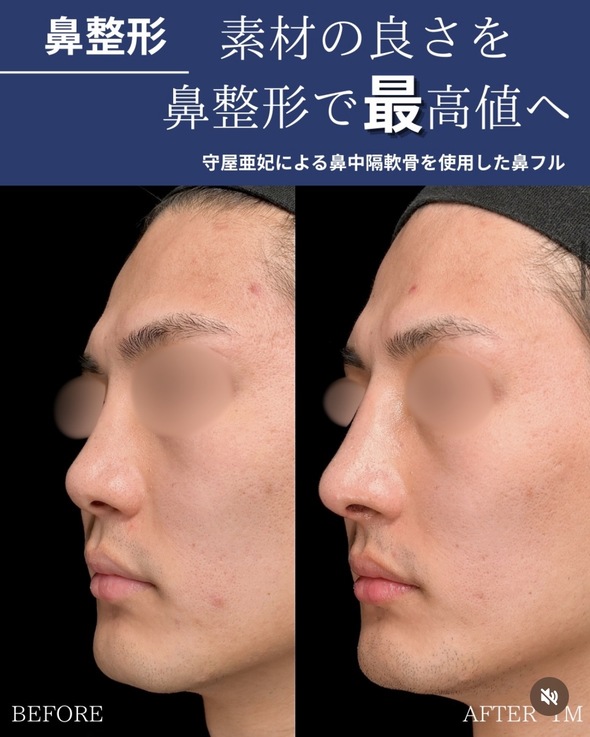鼻整形のビフォーアフターの写真