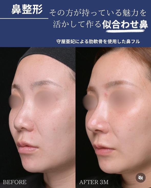 鼻整形のビフォーアフターの写真