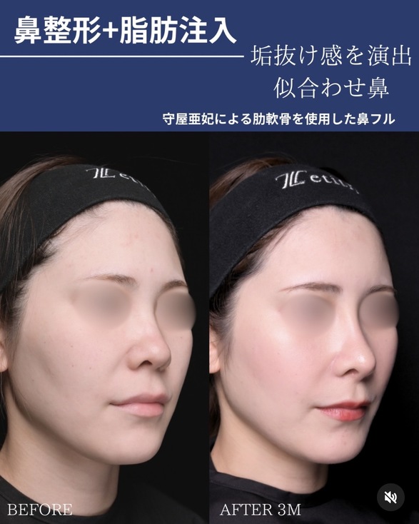 鼻整形のビフォーアフターの写真