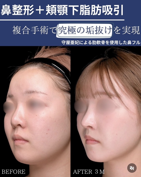 鼻整形のビフォーアフターの写真