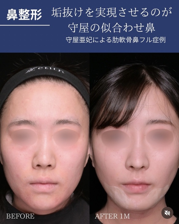 鼻整形のビフォーアフターの写真