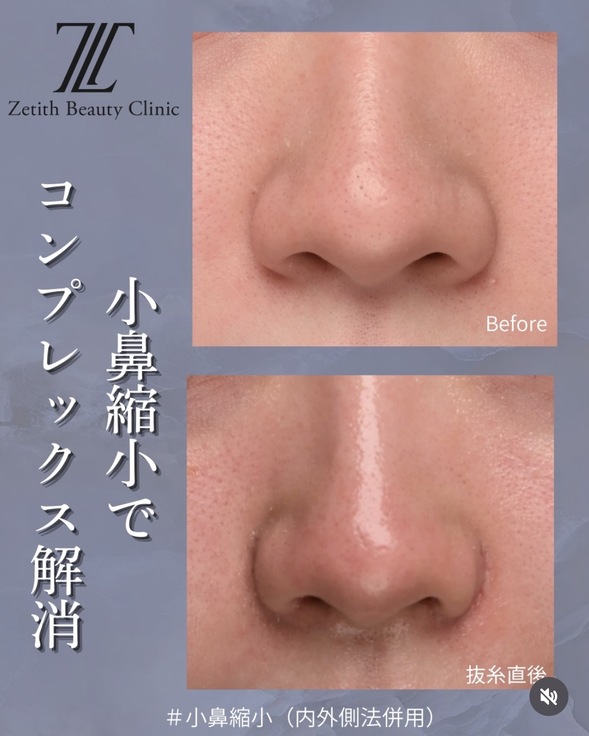 鼻整形のビフォーアフターの写真
