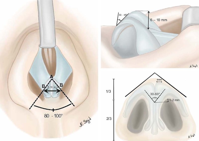 . (Left) The tip diamond shape is formed by the (A) supratip break, (B) tip-defining points, and (C) infratip