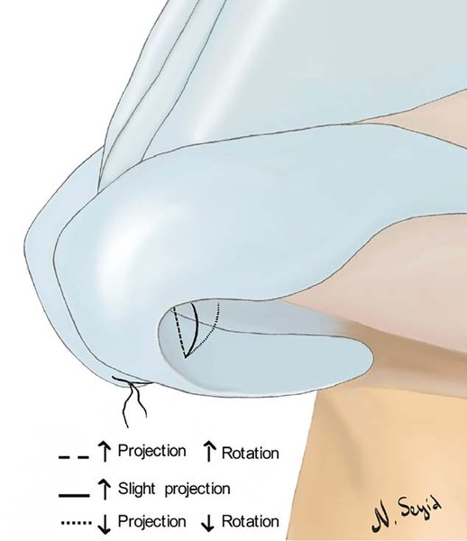 . The columellar septal suture may be adjusted to alter Fig. 9. The alar sill excision is trapezoidal. The medial aspect