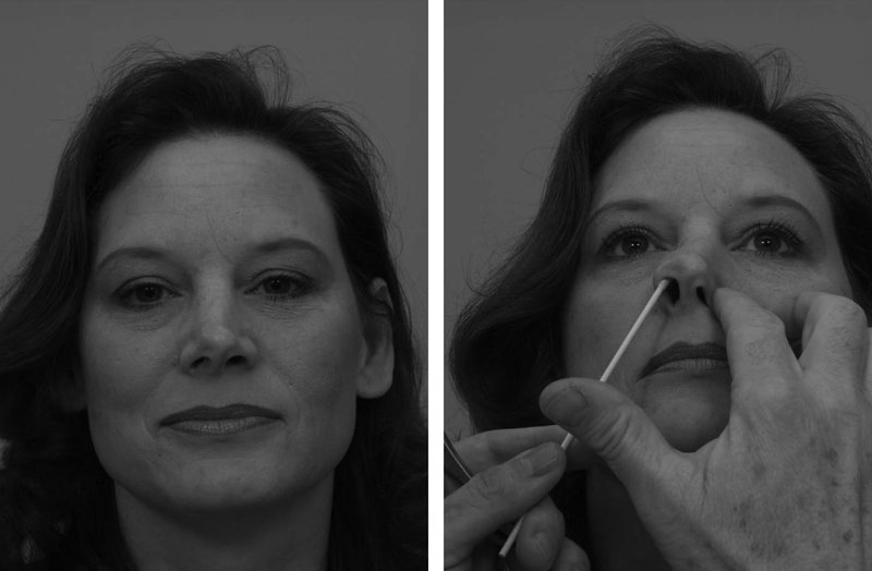 . Drawingsofcriticalnasalairwayanatomy. Onthe also narrow with improvement in airflow, when cotton tip