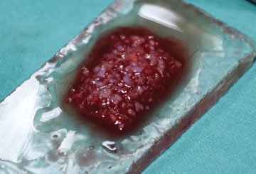 Mixingautologousfibringluewithdicedcartilage. Fig.4 Lyingstickycartilageoverthebonyandcartilagedorsum.