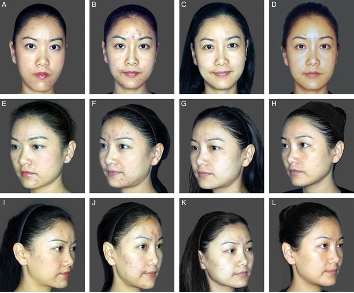 . (A, E, I) Day0pre-treatment,(B, F, J) Day113post-treatment,(C, G, K) Day239post-treatment, and(D,