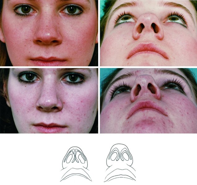 . (Above) A patient whose bulbous tip was caused in large measure by an excessive angle of the inter