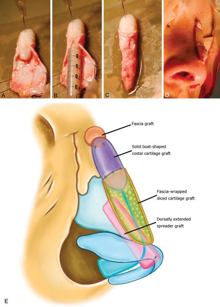 Techniqueofhybridnasaldorsalgrafts.(A) Thetemporalfasciaissuturedtothesolidboat-shapedcostalcartilagegraft.(B) Diced