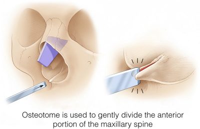 前鼻棘の骨切り手技イラスト