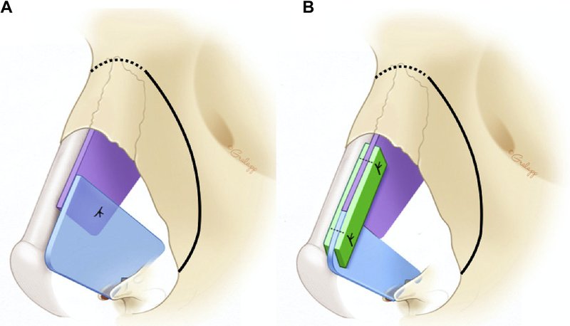 . In a structural preservation rhinoplasty approach using the modified subdorsal strip method, modified