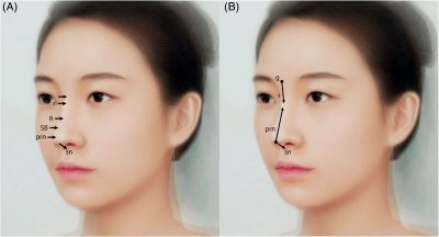 Thesequenceofastructuredfillerrhinoplasty(A) witha27Gneedle,(B) witha23Gcannula. g, glabella; r, radix; R, rhinion; SB,
