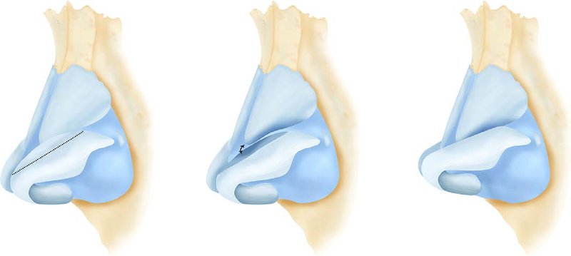 . Cephalic trim of the lateral crus of the lower lateral cartilages. (From Afrooz PN, Carboy JA, Men