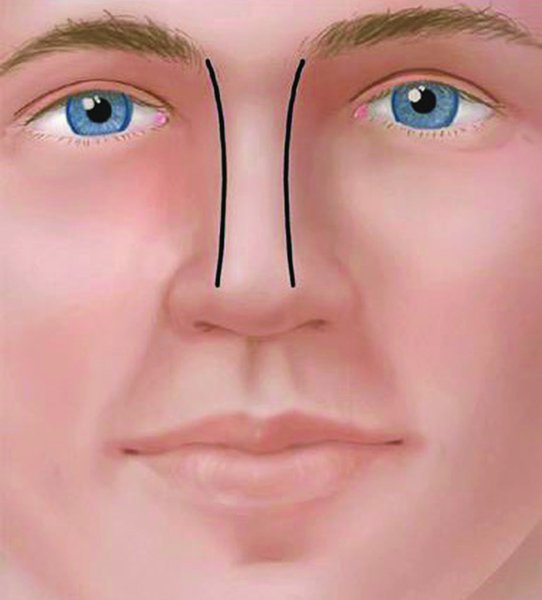 . The nasal dorsum of a man is wider and straighter (repro-