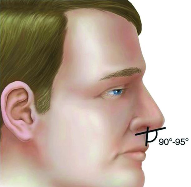 . The nasolabial angle should be between 90 and