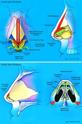 . Patient 2 underwent an open rhinoplasty (transcolumellar incision) with component