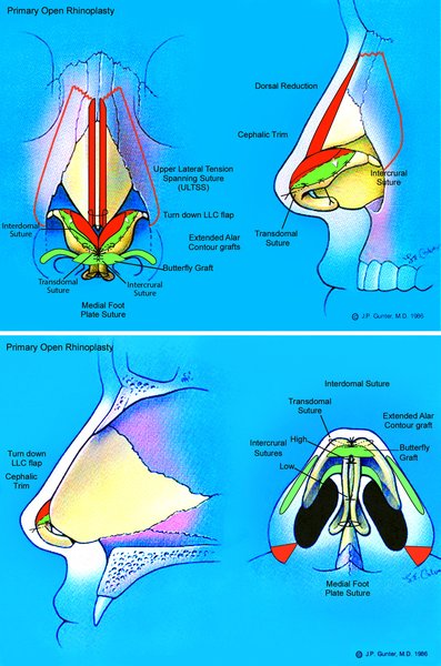 . Patient 2 underwent an open rhinoplasty (transcolumellar incision) with component