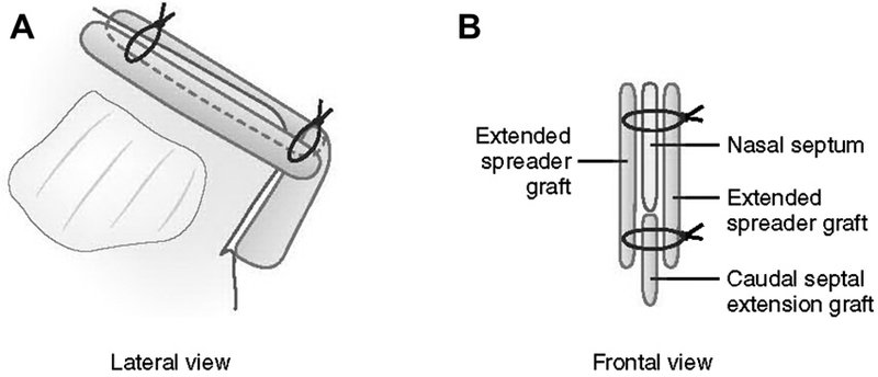 . Caudal septal extension graft, bilateral spreader grafts, and splinting grafts. (A) Lateral view. (B) Cross