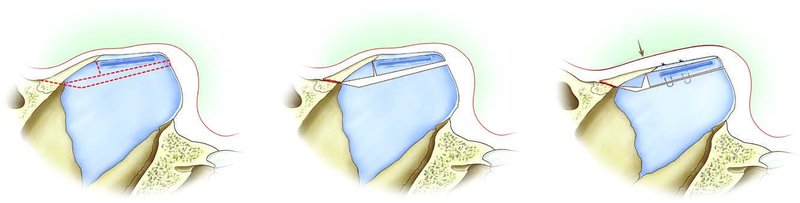 . Submucosal spreader grafts placed high on the septum in the submucoperichondrial tunnel above intermediate level