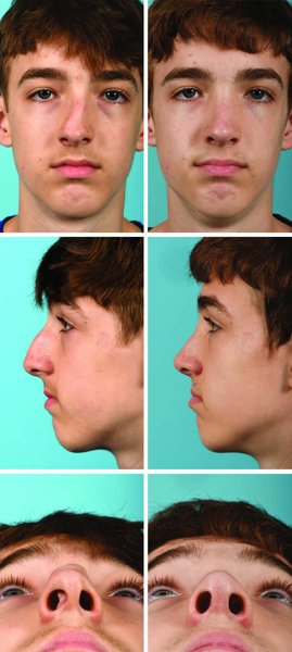 . Patient with severely deviated nose with large dorsal hump and