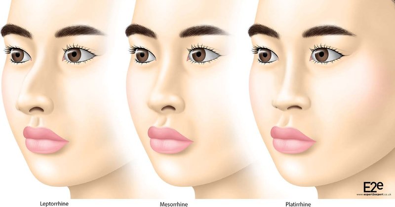 . General features of the Asian nose compared with other racial groups. In general, Caucasians have a narrow nose (lep-