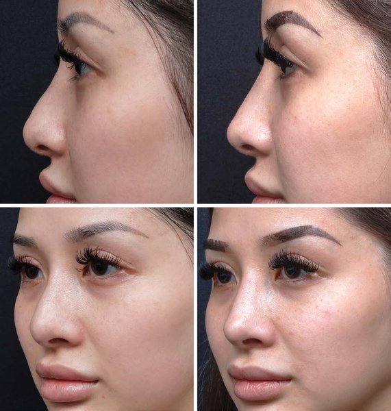 . Before-and-after photographs of a 28-year-old woman who desired a straighter,