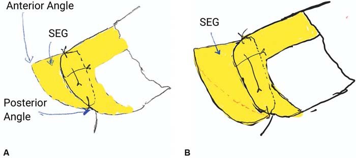 Incasesofretractedpremaxillaandcolumella, itisbesttonotusetheseptalextensiongraft(SEG) toaugmenttheanteriorspineorthe