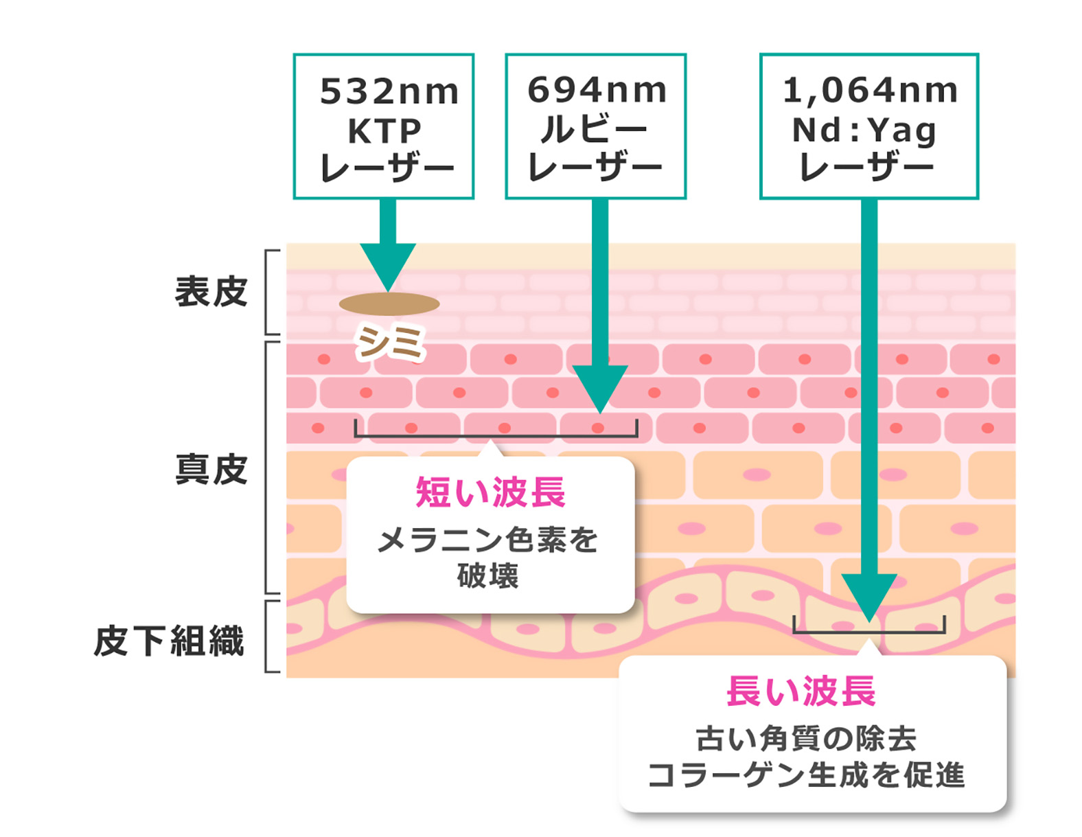 狙ったターゲットに合わせて最適な波長を選択することができるので、治療のバリエーションも多く、”目立つシミ