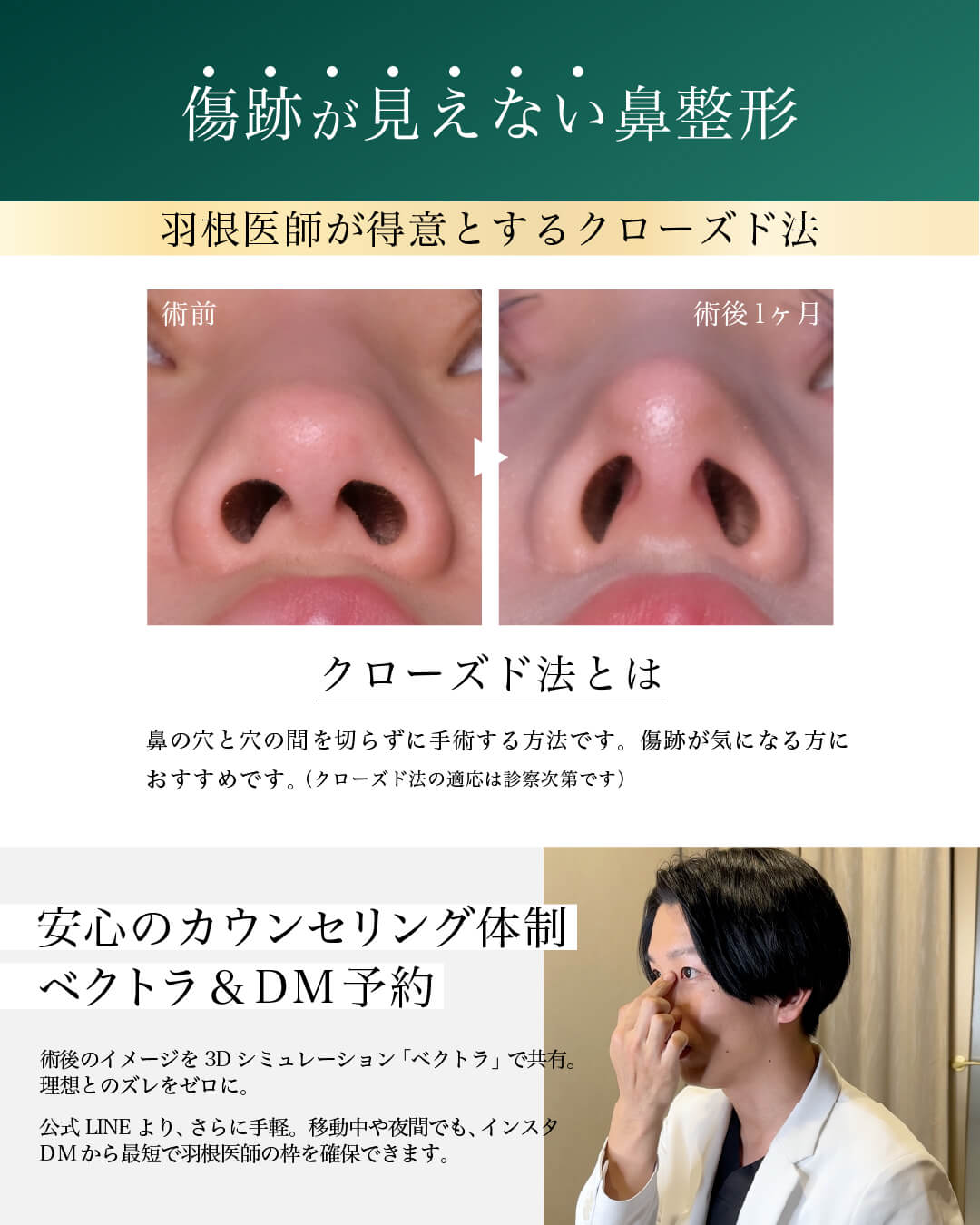 傷跡が見えない鼻整形 羽根医師が得意とするクローズド法 クローズド法とは 鼻の穴と穴の間（点線の部分）を切らずに手術する方法です。傷跡が気になる方におすすめです。（クローズド法の適応は診察次第です） 安心のカウンセリング体制 ベクトラ＆DM予約 術後のイメージを3Dシミュレーション「ベクトラ」で共有。理想とのズレをゼロに。公式LINEより、さらに手軽。移動中や夜間でも、インスタDMから最短で羽根医師の枠を確保できます。