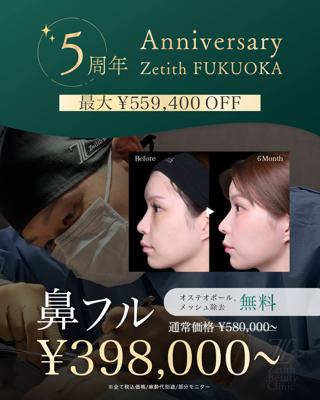 【ご好評につき延長決定】5周年記念｜鼻フル定額：特別キャンペーン
