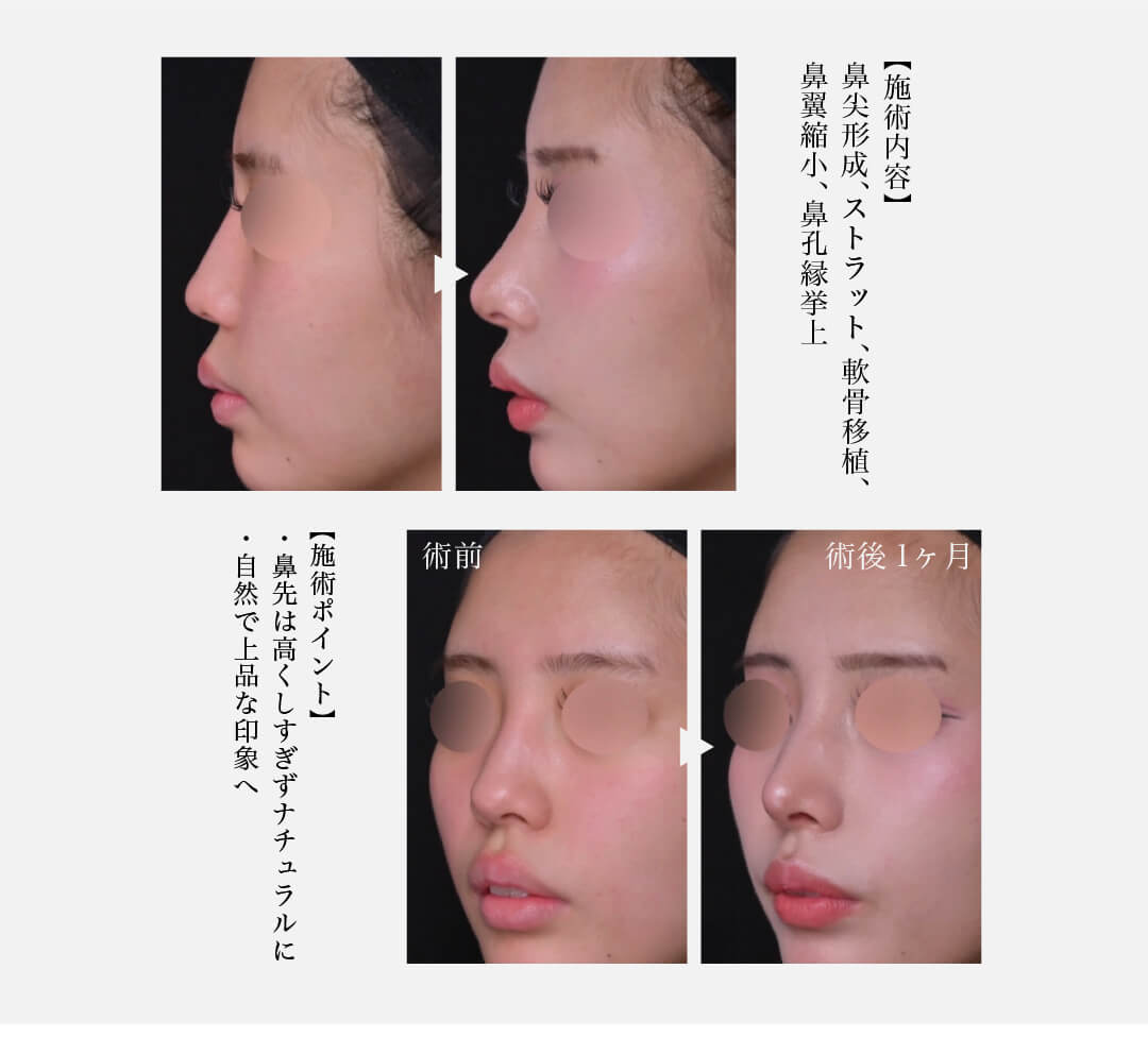 【施術内容】鼻尖形成、ストラット、軟骨移植、鼻翼縮小、鼻孔縁挙上 【施術ポイント】 ・鼻先は高くしすぎずナチュラルに ・自然で上品な印象へ